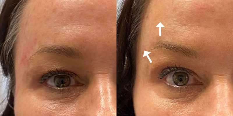 Get A Brow Lift Too!